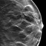 Breast-X-ray
