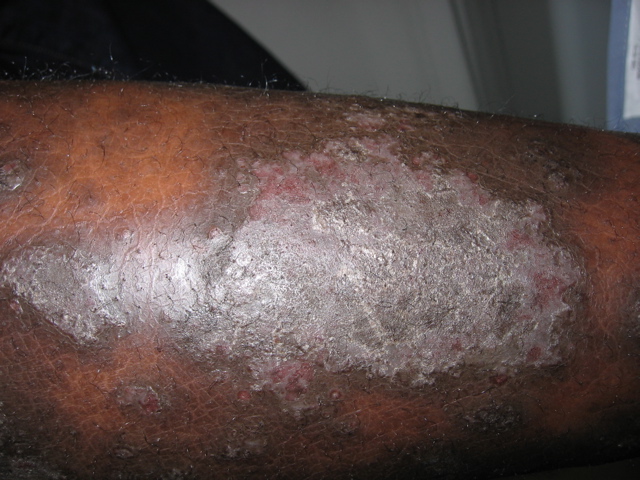 Psoriasis Black Skin Image Source Dermatologytimes Dr Darams 